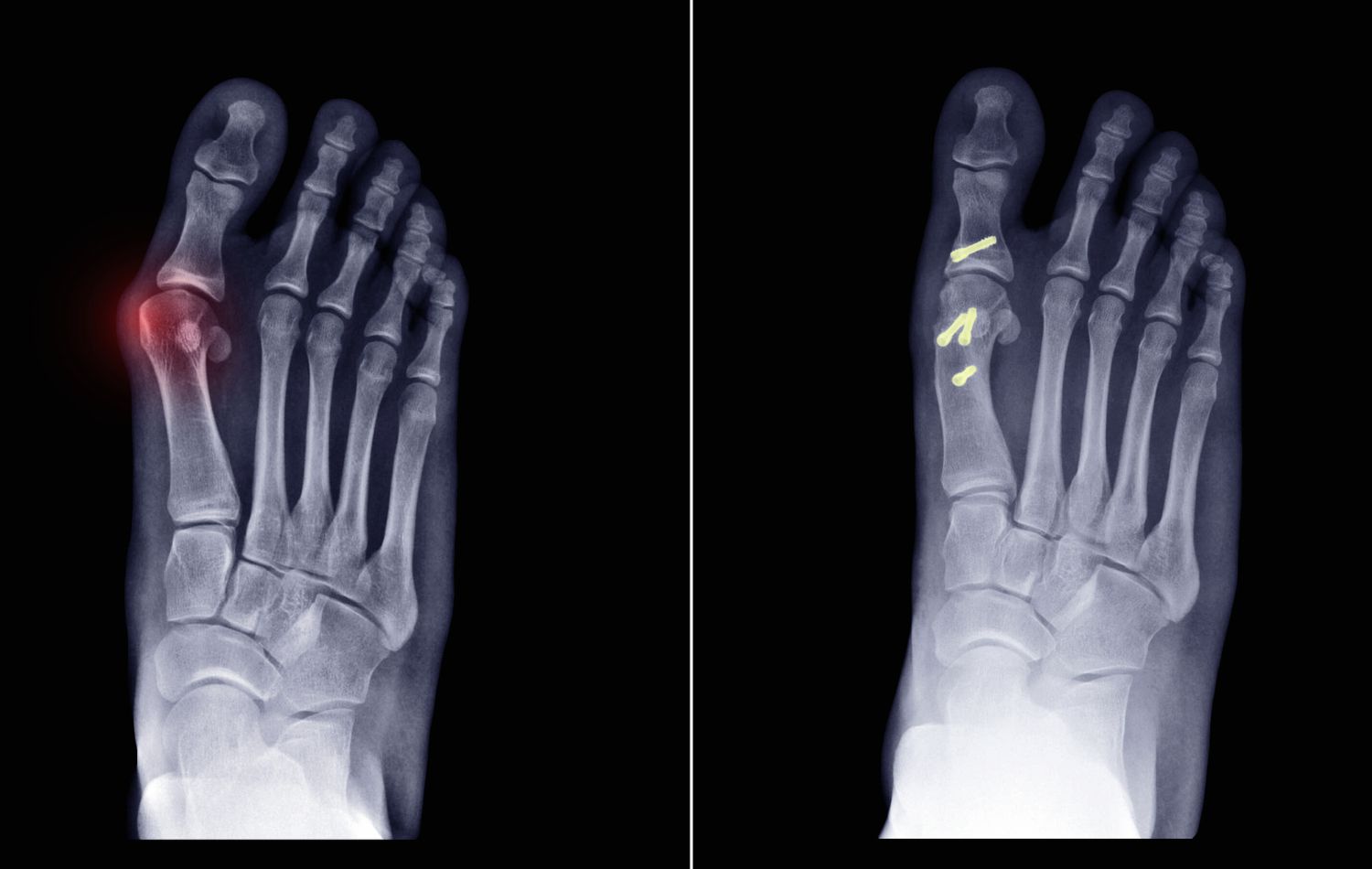 Chirurgie Mini-Invasive pour l’Oignon du Pied