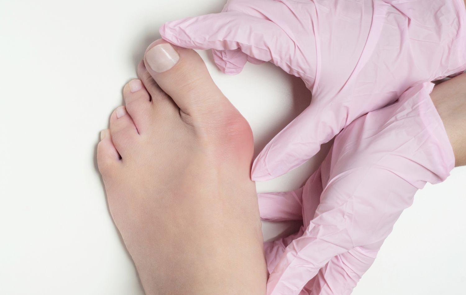 Hallux Valgus Pourquoi la Chirurgie Mini-Invasive